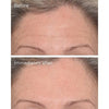 Targeted Wrinkle Corrector - USTRADA