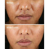 Rapid Relief Acne Sulfur Mask - USTRADA