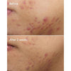 Deep Relief Acne Treatment - USTRADA