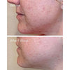 AHA/BHA/Retinoid Daily Clarifying Peel - USTRADA